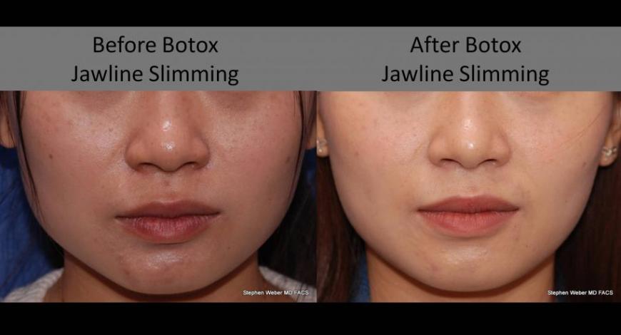 Non-Surgical Jawline Shaping with Botox