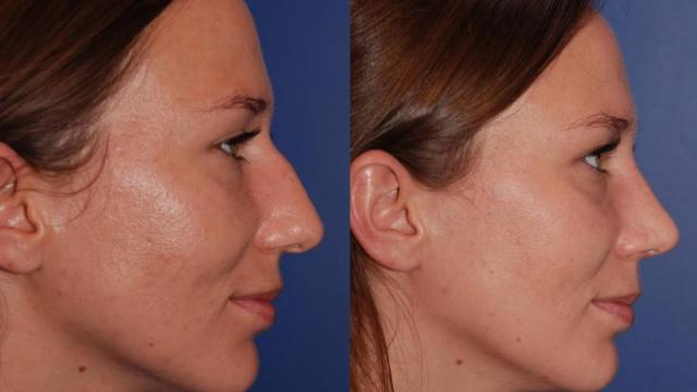 Rhinoplasty Before and After in Denver Colorado