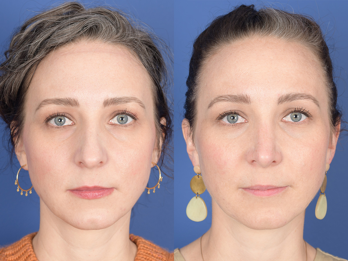 Rhinoplasty Before And After Weber Facial Plastic Surgery 6071